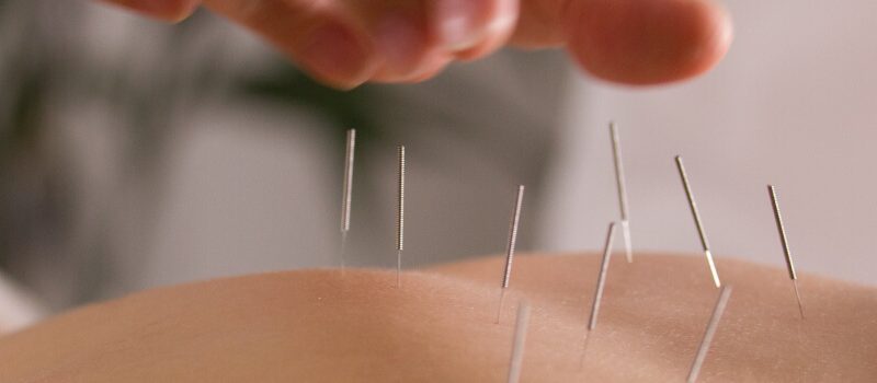 Acupuncture in Charleston SC